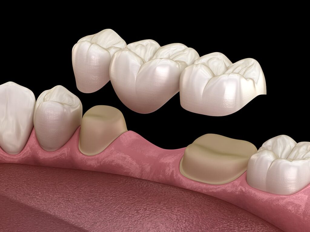 dental bridges 