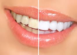 Zoom! teeth whitening