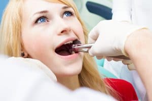 wisdom tooth extraction