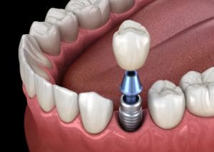 dental implants