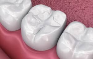 tooth colored fillings