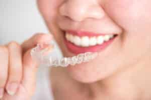 clear aligners