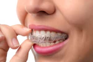 Invisalign special offer